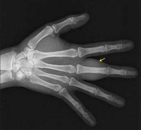 Ewing Sarcoma Causes Symptoms And Treatment 57 Off