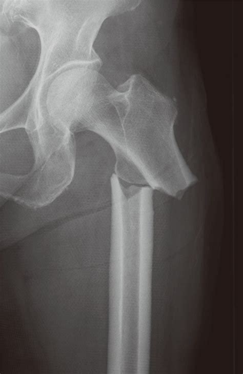 Subtrochanteric Fracture Of Femur Without Trauma In A Patient With A