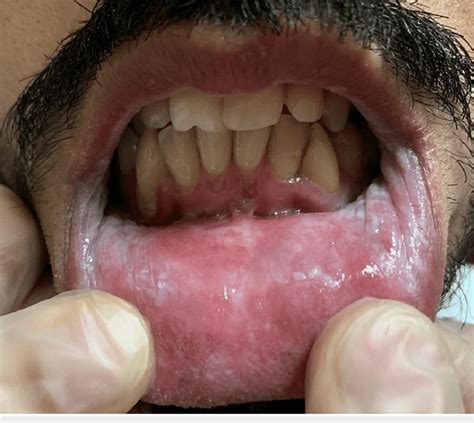 Clinical Picture Of The Lower Labial Mucosa White Plaques Of The Lower