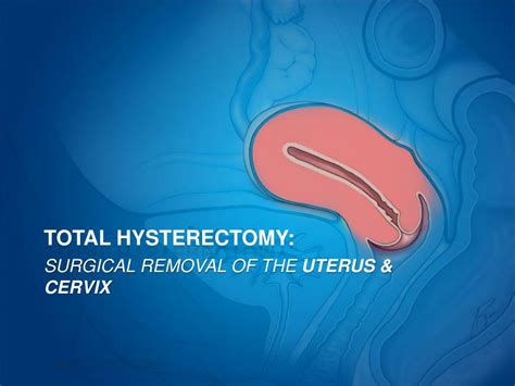 Ppt Focus Hysterectomy Powerpoint Presentation Free Download Id