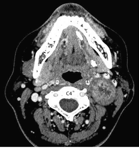 Figure From Cervical Sympathetic Chain Schwannoma Semantic Scholar