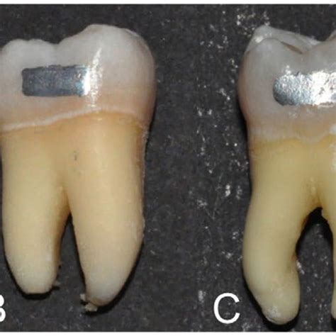 Class V Buccal Amalgam Restorations Consisting Of 25 50 75 And 100