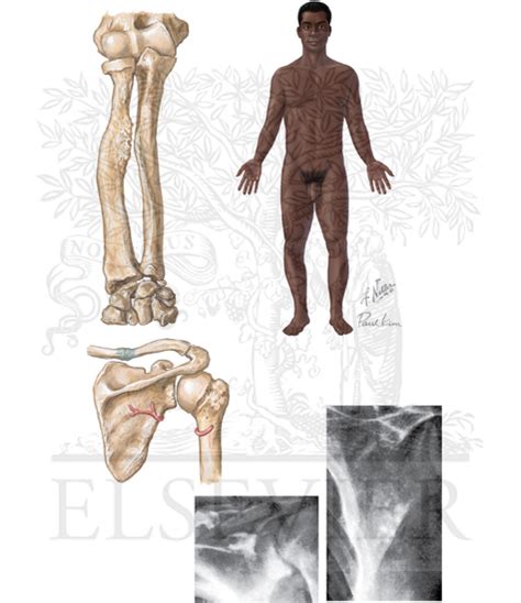 Clinical Manifestations Of Osteomalacia In Adults