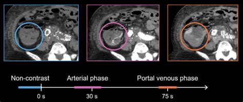 Abdominal Ct Phases • Litfl • Radiology Library