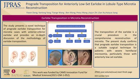 Prograde Transposition For Anteriorly Low Set Earlobe In Lobule Type