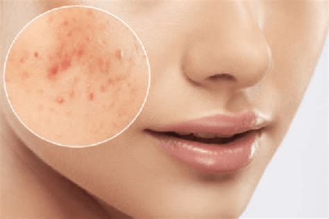 Best Acne Scar Treatments In Singapore As Of