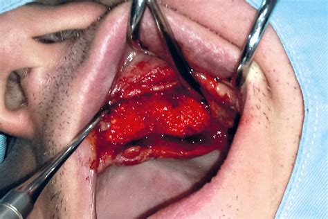 Maxillary Ridge Augmentation Using Permamem Cerabone And Autologous