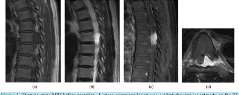 Figure 1 From Spinal Epidural Cavernous Hemangioma Of The Thoracic