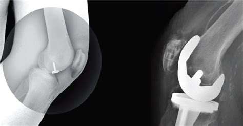 Focal Resurfacing Implants Knee Replacements In London