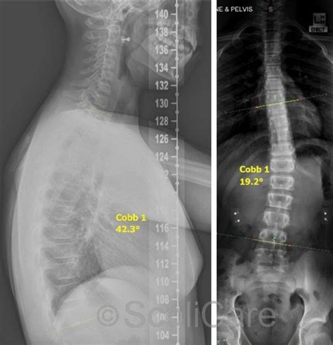 Case Study Thoracolumbar Scoliosis Treatment For A Girl