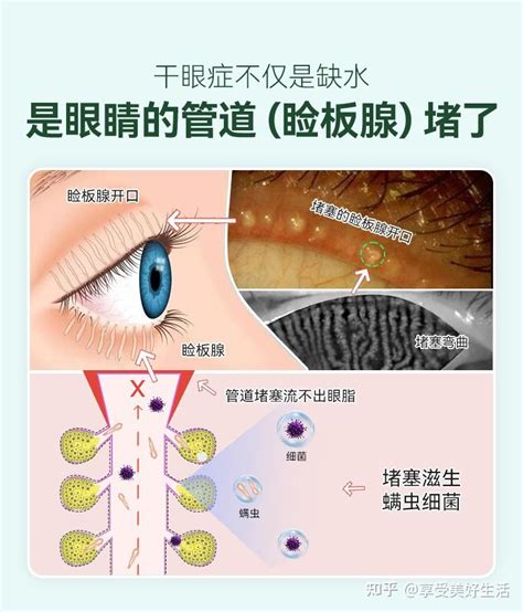 皇室御用品牌英国眼博士the Eye Doctor茶树油湿巾，给干眼症患者带来福音 知乎