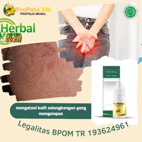 Jual Cara Mengatasi Kulit Selangkangan Yang Mengelupas Obat