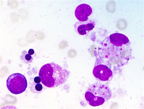 Pathology Outlines Hemophagocytic Lymphohistiocytosis