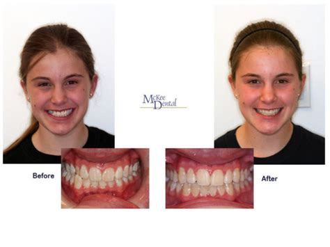 Crossbite Correction