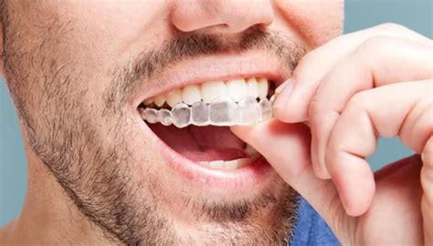 Braces Vs Invisalign Choosing The Right Orthodontic Treatment