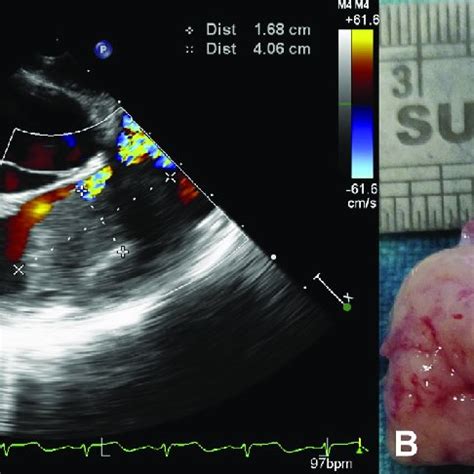 A Twodimensional Transesophageal Image Right Ventricular Inflow