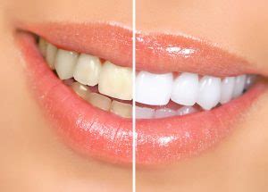 Teeth Whitening in Dallas, TX | Playa Dental