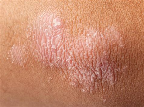 Tanning Bed Rash Images At Tammy Pough Blog