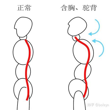 对于小朋友改善含胸、驼背的一点思考 知乎