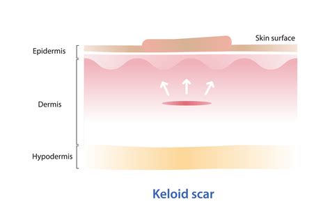 Keloid Scar On Skin Surface Vector Illustration Isolated On White Background Cross Section Of