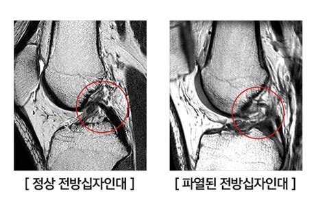 십자인대 파열 더 이상 남성 전유물 아니다