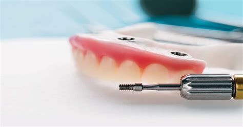 Decision-Making in Restoring an Implant-Supported Overdenture