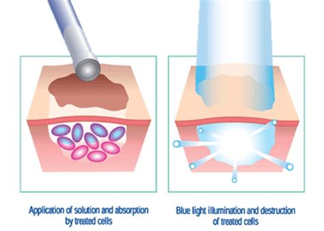 Blue Light Photodynamic Therapy Dermatology | Shelly Lighting