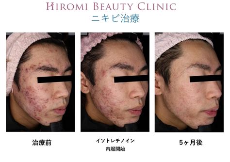 ニキビ治療♪トレチノイン内服♪ Hiromi Beauty Clinic 院長 兵田 優美のブログ『女医hiromi´s Beauty