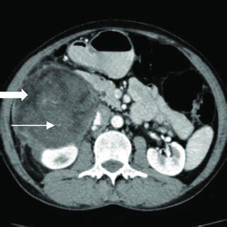 Axial contrast-enhanced computed tomography (CT) of the abdomen shows a... | Download Scientific ...