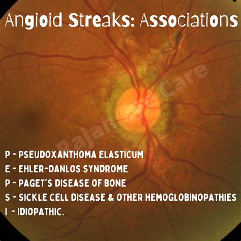 Weekend Bytes Associations Of Angioid Streaks