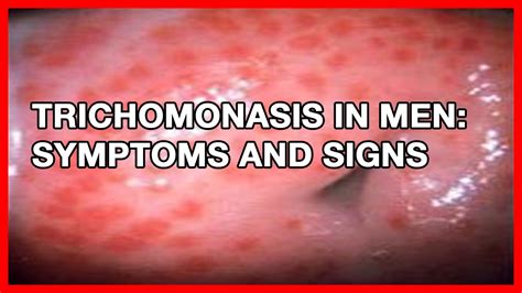 Trichomonasis In Men Symptoms And Signs And How To Treat It Youtube