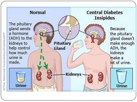 Diabetes Insipidus As Related To Endocrine System Hormones Pictures