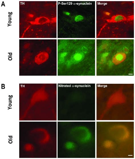 Phosphorylated And Nitrated A Synuclein Immunoreactivity Is Enhanced