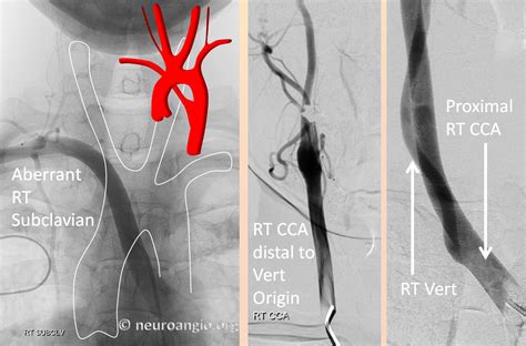 Aortic Arch