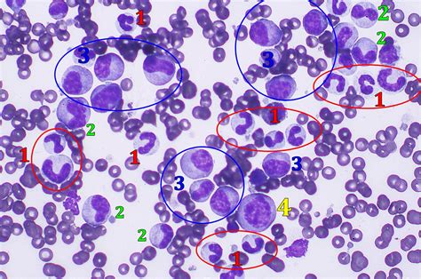 Leucemia Mieloide Aguda Sintomas