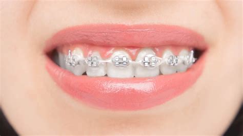 Brackets Invisibles Qu Son Tipos Y Cuidades