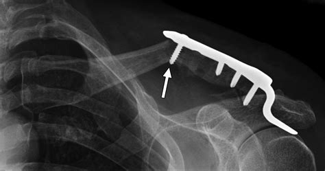 Acromioclavicular Joint The Other Joint In The Shoulder Ajr