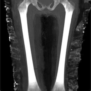 Thick Slab Maximum Intensity Projection MIP Coronal Reconstruction