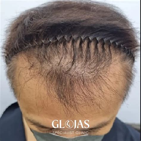 Leading Fue Hair Transplant Malaysia Specialist Clinic