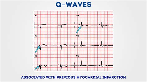 How To Read An Ecg Ecg Interpretation Ekg Geeky Medics