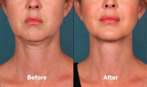 Kybella Mclean Potomac Dermatology