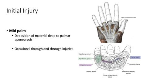 High Pressure Injection Injuries Dr Sean Nicklin