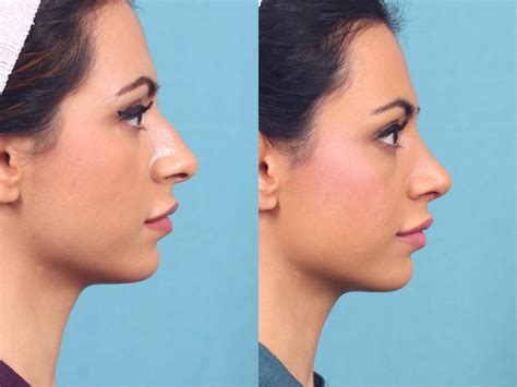 Rinoplastia Ultrasónica Qué Es Beneficios Y Resultados Blog Cirugía