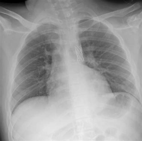 Portable Chest X Ray The Presence Of A Projected Aortic Stent Is