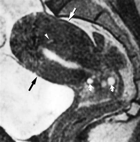 Diffuse And Focal Adenomyosis Mr Imaging Findings Radiographics