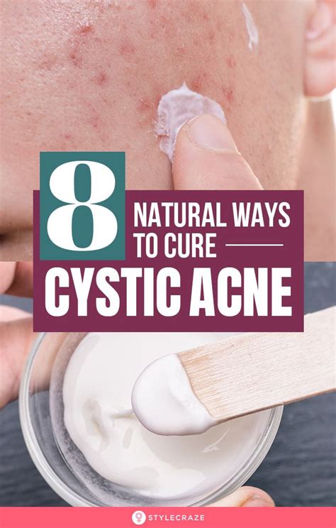 Cystic Acne What Is It And How To Heal It In Facial Care