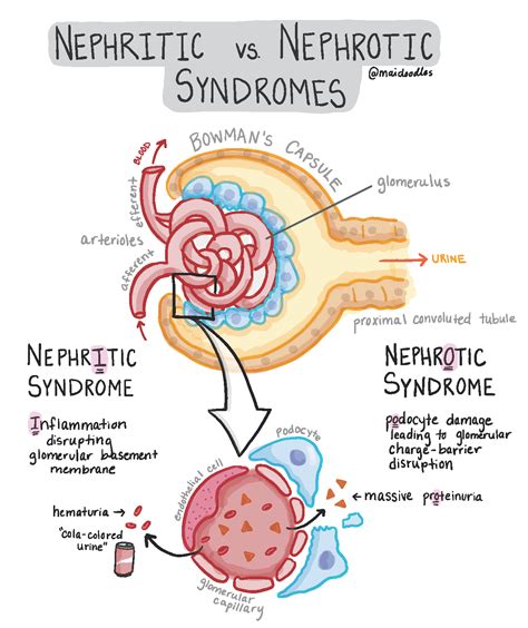 Nephrotic Syndrome