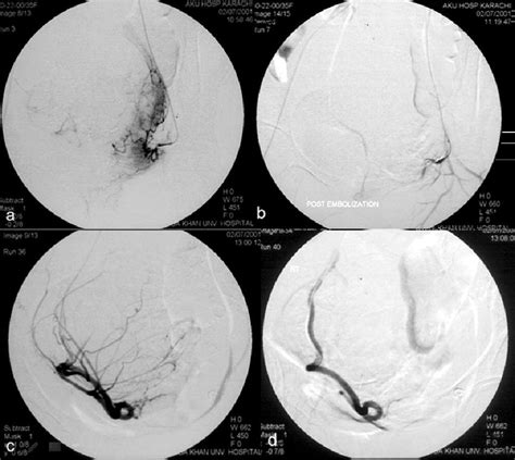 Bilateral Uterine Artery Embolization In Patient With A Large Uterine Download Scientific