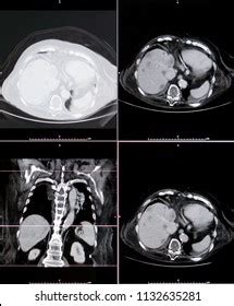 Computed Tomography Ct Scan Chest Abdomen Stock Photo