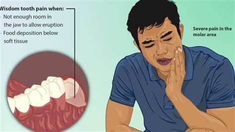 Wisdom Teeth Coming In Pain Boston Dentist Congress Dental Group